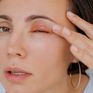 Врач предостерег от опасных действий при ячмене на глазу